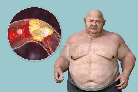 Photo for Obesity and atherosclerosis, conceptual 3D illustration showing atheromatous plaque inside artery leading to narrowing of blood vessel in an obese person. Metabolic disorders in overweight patient - Royalty Free Image