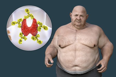 Téléchargez les photos : Association between autoimmune thyroid disease and obesity, conceptual 3D illustration showing an overweight patient and thyroid gland attacked by antibodies - en image libre de droit
