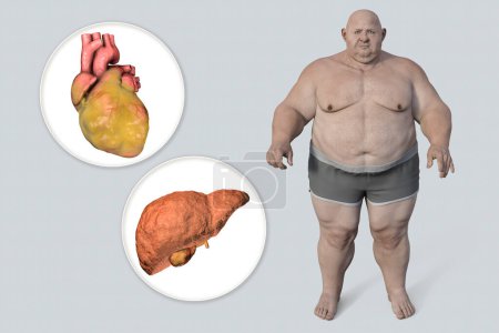 Téléchargez les photos : Obese heart and liver in overweight man, 3D illustration. Concept of obesity and inner organs disease. Heart obesity with increased risk of cardiovascular disease, heart failure, liver steatosis - en image libre de droit