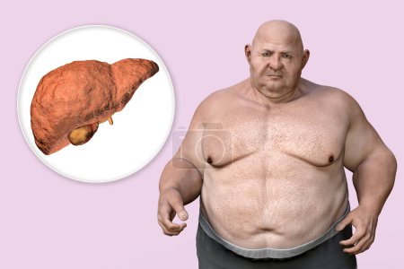 Téléchargez les photos : Foie fibrotique chez l'homme obèse, illustration 3D. Concept d'obésité et maladies des organes internes, problème comportemental, trouble de l'alimentation excessive, dépendance alimentaire. Stéatose hépatique et stéatohépatite - en image libre de droit