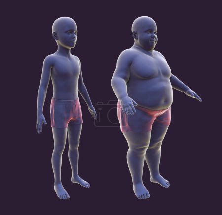 Übergewichtiger Junge vor und nach der Gewichtszunahme, 3D-Illustration. Konzept der Fettleibigkeit, Verhaltensprobleme, psychiatrische Erkrankungen, Binge-Eating-Störung, Esssucht