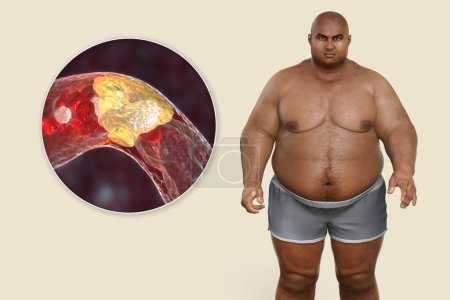 Photo for Obesity and atherosclerosis, conceptual 3D illustration showing atheromatous plaque inside artery leading to narrowing of blood vessel in an obese person. Metabolic disorders in overweight patient - Royalty Free Image