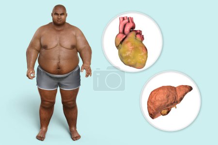 Téléchargez les photos : Obese heart and liver in overweight man, 3D illustration. Concept of obesity and inner organs disease. Heart obesity with increased risk of cardiovascular disease, heart failure, liver steatosis - en image libre de droit