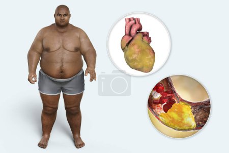 Photo for Obesity and atherosclerosis, conceptual 3D illustration showing atheromatous plaque inside artery of obese heart leading to narrowing of blood vessel in an obese person - Royalty Free Image