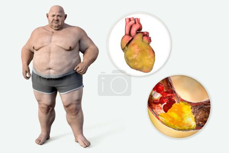 Photo for Obesity and atherosclerosis, conceptual 3D illustration showing atheromatous plaque inside artery of obese heart leading to narrowing of blood vessel in an obese person - Royalty Free Image