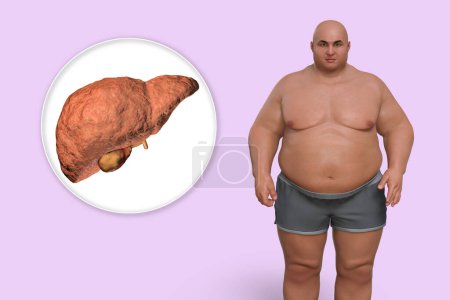 Téléchargez les photos : Foie fibrotique chez l'homme obèse, illustration 3D. Concept d'obésité et maladies des organes internes, problème comportemental, trouble de l'alimentation excessive, dépendance alimentaire. Stéatose hépatique et stéatohépatite - en image libre de droit