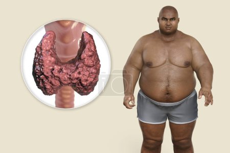 Photo for Association between autoimmune thyroid disease and obesity, conceptual 3D illustration showing an overweight patient and thyroid gland attacked by antibodies - Royalty Free Image