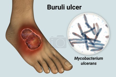 Photo for Buruli ulcer, a chronic debilitating disease affecting skin and subcutaneous tissues found mainly in tropical and subtropical countries caused by bacteria Mycobacterium ulcerans, 3D illustration - Royalty Free Image