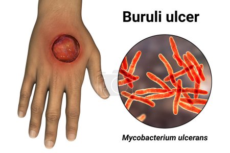 Photo for Buruli ulcer, a chronic debilitating disease affecting skin and subcutaneous tissues found mainly in tropical and subtropical countries caused by bacteria Mycobacterium ulcerans, 3D illustration - Royalty Free Image