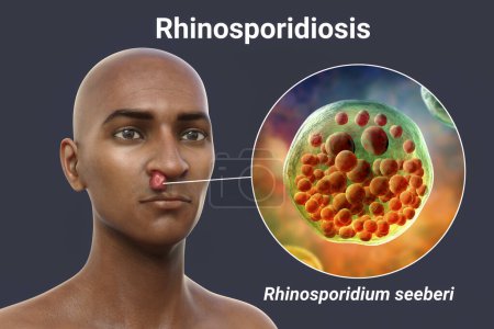 Téléchargez les photos : Nasal rhinosporidiosis in a patient, 3D illustration. A disease caused by Rhinosporidium seeberi parasite, leads to formation of polypoidal masses in nasopharynx and conjunctiva - en image libre de droit