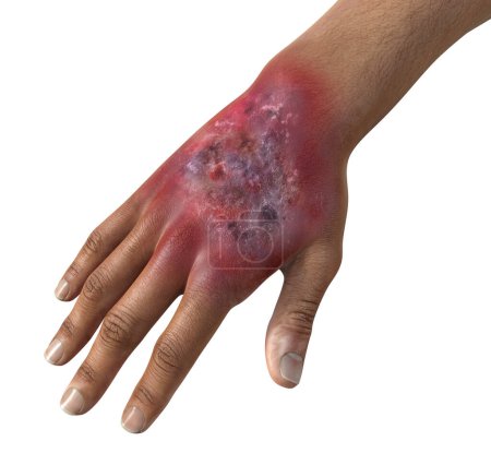 Photo for Protothecosis infection on human hand, 3D illustration. A disease caused by Prototheca wickerhamii green algae - Royalty Free Image