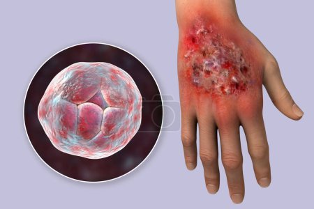 Téléchargez les photos : Protothecosis infection on human hand and close-up view of Prototheca wickerhamii green algae, the causative agent of the disease, illustration 3D - en image libre de droit