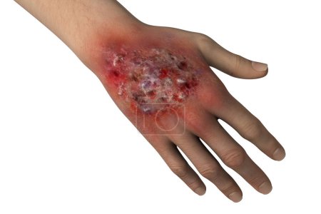 Téléchargez les photos : Protothecosis infection on human hand, illustration 3D. Une maladie causée par les algues vertes Prototheca wickerhamii - en image libre de droit