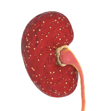 Foto de Acute pyelonephritis, medical concept, 3D illustration showing focal small abscesses in kidney tissue and purulent exudate covering congestive mucosa of renal pelvix - Imagen libre de derechos