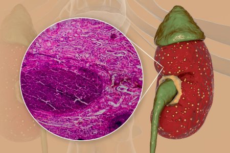 Foto de Pielonefritis aguda, ilustración 3D que muestra morfología macroscópica con pequeños abscesos focales en tejido renal y micrografía ligera que muestra histopatología de microabscesos - Imagen libre de derechos