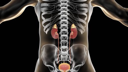 Foto de Acute pyelonephritis, medical concept, 3D illustration showing focal small abscesses in kidney tissue and purulent exudate covering congestive mucosa of renal pelvix - Imagen libre de derechos