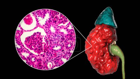 Foto de Pielonefritis crónica, ilustración 3D que muestra morfología macroscópica con superficie cortical cicatrizada irregular y micrografía ligera que muestra fibrosis intersticial e inflamación - Imagen libre de derechos