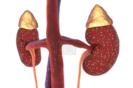 Téléchargez les photos : Pyelonephritis, medical concept, 3D illustration showing presence of purulent blisters in kidney tissue - en image libre de droit