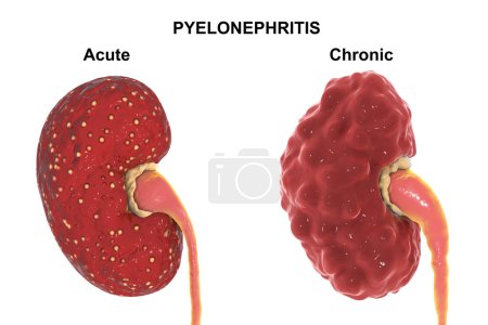 Téléchargez les photos : Acute and chronic pyelonephritis, medical concept, 3D illustration showing focal abscesses in kidney tissue in acute form, irregular scarred cortical surface and dilated ureter in chronic - en image libre de droit
