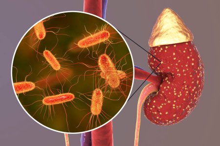 Foto de Pielonefritis, concepto médico, y vista de cerca de las bacterias Escherichia coli, el agente causal común de la infección renal, ilustración 3D - Imagen libre de derechos