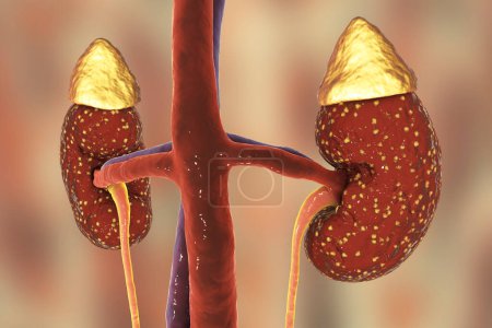 Foto de Pyelonephritis, medical concept, 3D illustration showing presence of purulent blisters in kidney tissue - Imagen libre de derechos
