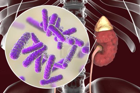 Foto de Pyelonephritis, medical concept, and close-up view of bacteria, causative agent of kidney infection, 3D illustration - Imagen libre de derechos
