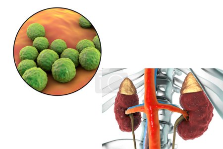 Téléchargez les photos : Pyelonephritis, medical concept, and close-up view of bacteria Enterococcus, the common causative agent of kidney infection, 3D illustration - en image libre de droit