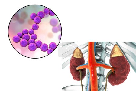 Foto de Pyelonephritis, medical concept, and close-up view of bacteria Enterococcus, the common causative agent of kidney infection, 3D illustration - Imagen libre de derechos