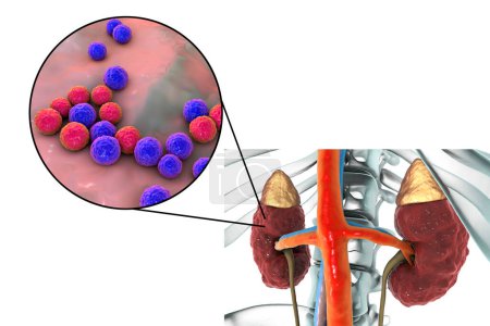 Foto de Pielonefritis, concepto médico y vista de cerca de las bacterias Enterococo, el agente causal común de la infección renal, ilustración 3D - Imagen libre de derechos