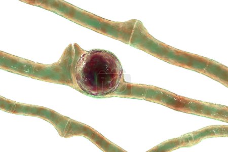 Foto de Basidiobolus ranarum hongos microscópicos, ilustración 3D. Causa mucormicosis subcutánea inflamatoria crónica, vista como hinchazón progresiva y grandes masas debajo de la piel - Imagen libre de derechos