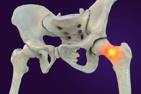 Téléchargez les photos : Fracture du cou du fémur, un type commun de fracture de la hanche qui survient généralement chez les personnes âgées et qui peut entraîner des problèmes de mobilité et d'autres complications, isolé sur fond blanc, illustration 3D - en image libre de droit