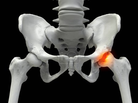 Os fémoral affecté par la maladie Legg-Calve-Perthes, un trouble de la hanche chez l'enfant qui affecte l'approvisionnement en sang de la tête fémorale, illustration 3D montre l'os fémoral gauche affecté (côté droit de l'image)