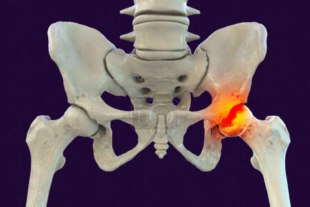 Femurknochen betroffen von Legg-Calve-Perthes-Krankheit, einer kindlichen Hüftstörung, die die Durchblutung des Hüftkopfes beeinträchtigt, 3D-Illustration zeigt betroffenen linken Femurknochen (rechte Seite des Bildes))