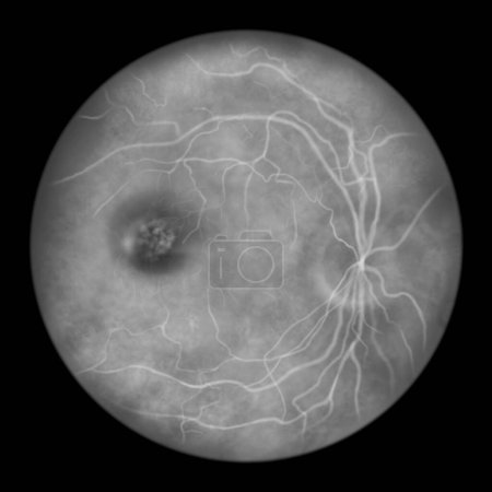 Foto de La mejor distrofia macular vitelliforme, estadio 3 pseudohipopión, estratificación de lipofusceína, ilustración científica, vista oftalmoscopio, angiografía fluoresceínica - Imagen libre de derechos