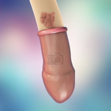 Photo for Common locations of genital warts, Human papillomavirus HPV lesions in men. 3D illustration showing ineffectiveness of comdom in protection against HPV transmission - Royalty Free Image