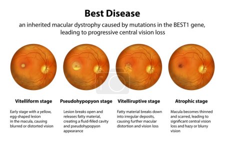 Photo for Stages of Best disease. Best vitelliform macular dystrophy stages with their description and ophthalmoscope view, scientific illustration - Royalty Free Image