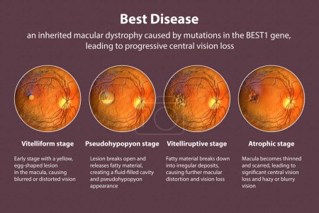 Foto de Etapas de la mejor enfermedad. Mejores etapas de distrofia macular vitelliforme con su descripción y vista oftalmoscópica, ilustración científica 3D - Imagen libre de derechos