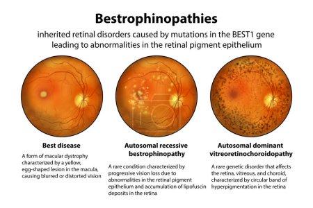 Photo for Bestrophinopathies, inherited retinal disorders caused by mutations in the BEST1 gene, illustration. Best disease, autosomal recessive bestrophinopathy and autosomal dominant vitreoretinochoroidopathy - Royalty Free Image
