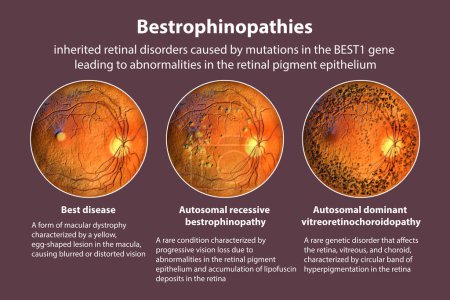 Photo for Bestrophinopathies, inherited retinal disorders caused by mutations in the BEST1 gene, 3D render. Best disease, autosomal recessive bestrophinopathy, and autosomal dominant vitreoretinochoroidopathy - Royalty Free Image