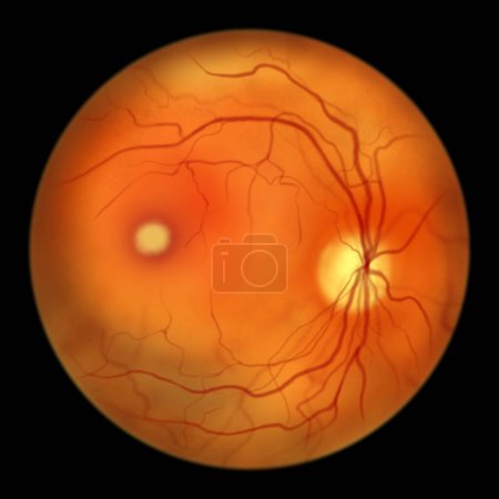 Photo for Best disease. Best vitelliform macular dystrophy, Vitelliform stage, classic egg-yolk lesion, scientific illustration, ophthalmoscope view - Royalty Free Image