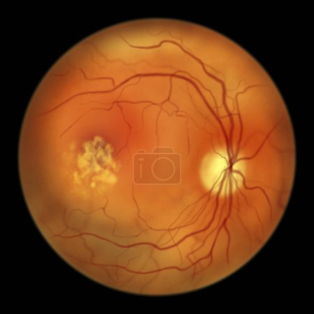 Photo for Best disease. Best vitelliform macular dystrophy, Vitelleruptive stage, scrambled egg appearance, scientific illustration, ophthalmoscope view - Royalty Free Image