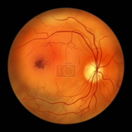 Photo for Best disease. Best vitelliform macular dystrophy, Atrophic stage, macular atrophy, scientific illustration, ophthalmoscope view - Royalty Free Image