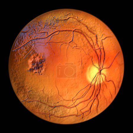 Photo for Best disease. Best vitelliform macular dystrophy, Atrophic stage, macular atrophy, scientific 3D illustration, ophthalmoscope view - Royalty Free Image