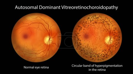 Foto de Vitreorretinocoroidopatía autosómica dominante, un raro trastorno genético que afecta a la retina, una ilustración que muestra retina ocular normal y retina con banda circular de hiperpigmentación - Imagen libre de derechos