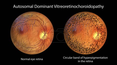 Photo for Autosomal dominant vitreoretinochoroidopathy, a rare genetic disorder that affects the retina, 3D illustration showing normal eye retina and retina with circular band of hyperpigmentation - Royalty Free Image