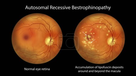 Photo for Autosomal recessive bestrophinopathy, scientific illustration showing normal eye retina and accumulation of lipofuscin deposits around and beyond the macula leading to progressive damage to the retina - Royalty Free Image