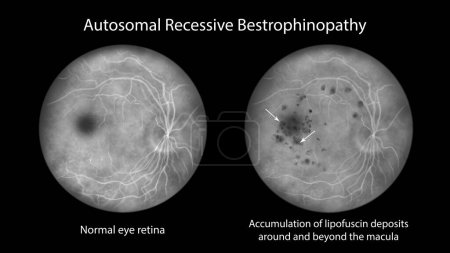 Téléchargez les photos : Bestrophinopathie autosomique récessive, illustration montrant une rétine oculaire normale et une accumulation de dépôts de lipofuscine autour et au-delà de la macula sur angiographie fluorescéine - en image libre de droit