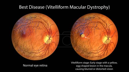Photo for Best disease, 3D illustration showing normal eye retina and Best vitelliform macular dystrophy, vitelliform stage with classic egg-yolk lesion, ophthalmoscope view - Royalty Free Image