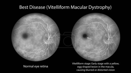 Photo for Best disease, illustration showing normal eye retina and Best vitelliform macular dystrophy, vitelliform stage with classic egg-yolk lesion on fluorescein angiography - Royalty Free Image