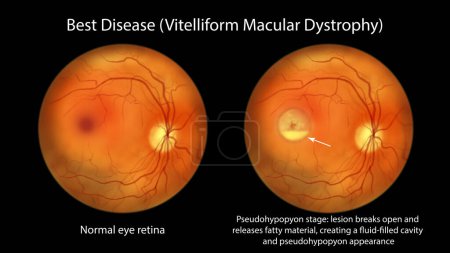 Photo for Best disease, illustration showing normal eye retina and Best vitelliform macular dystrophy, Pseudohypopyon stage with layering of lipofuscin, ophthalmoscope view - Royalty Free Image